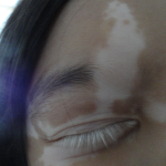 vitiligo face
